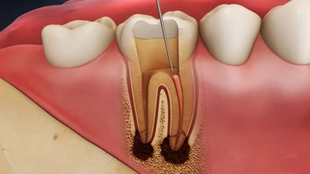 Chữa tủy răng giá bao nhiêu tại nha khoa Big Dental - 1