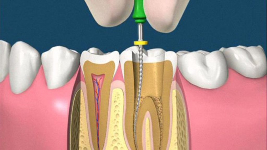 Chữa tủy răng giá bao nhiêu tại nha khoa Big Dental - 4