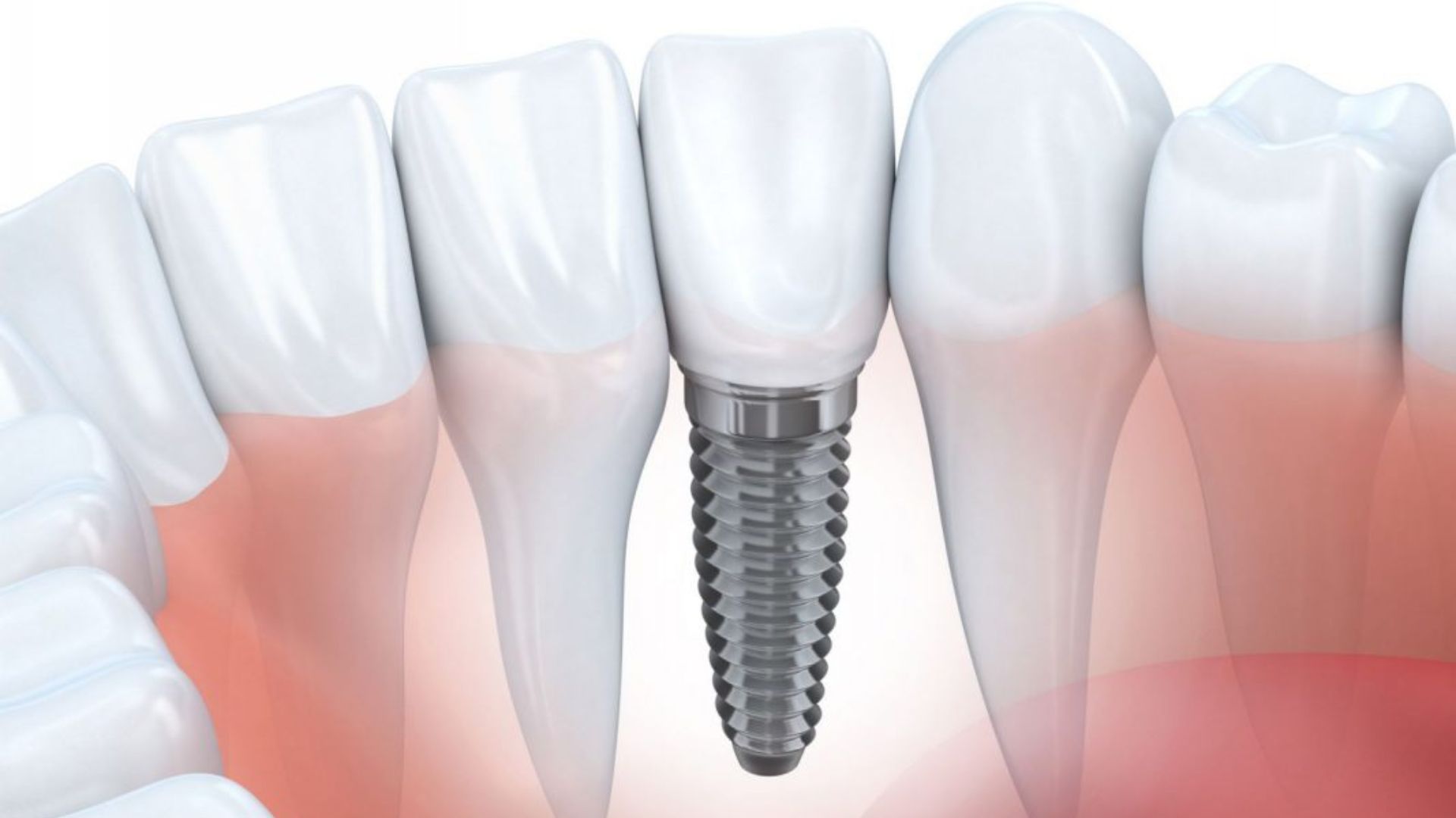 Trồng răng Implant Quận 1 - 4