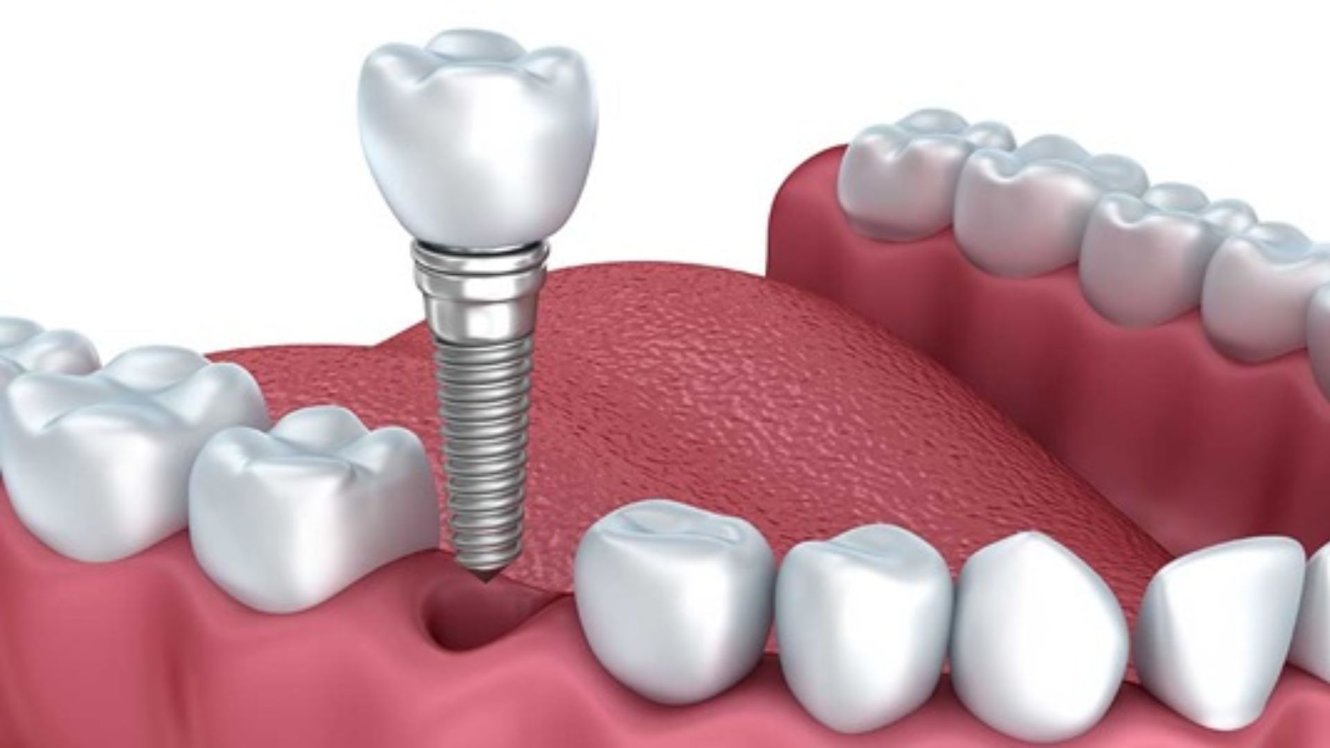 Trồng răng Implant Quận 1 - 1