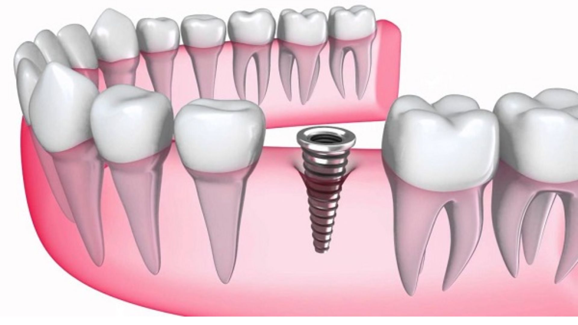 Trồng răng Implant giá bao nhiêu -1 