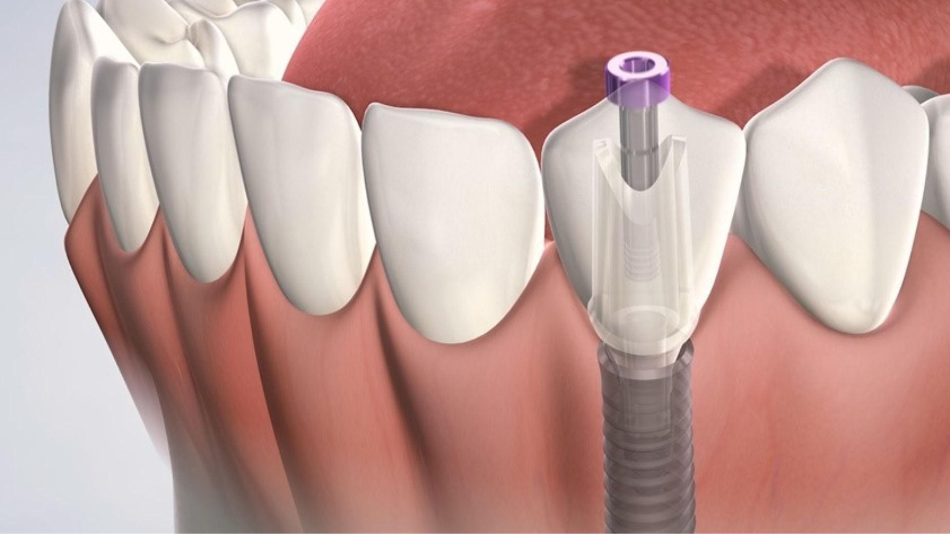 Trồng răng Implant mất bao lâu - 1