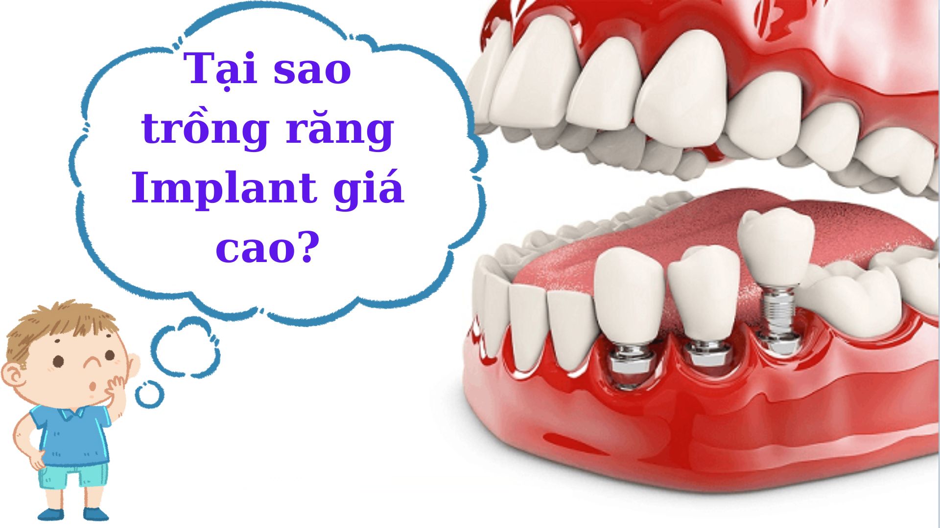 Bảng giá trồng răng Implant - 2