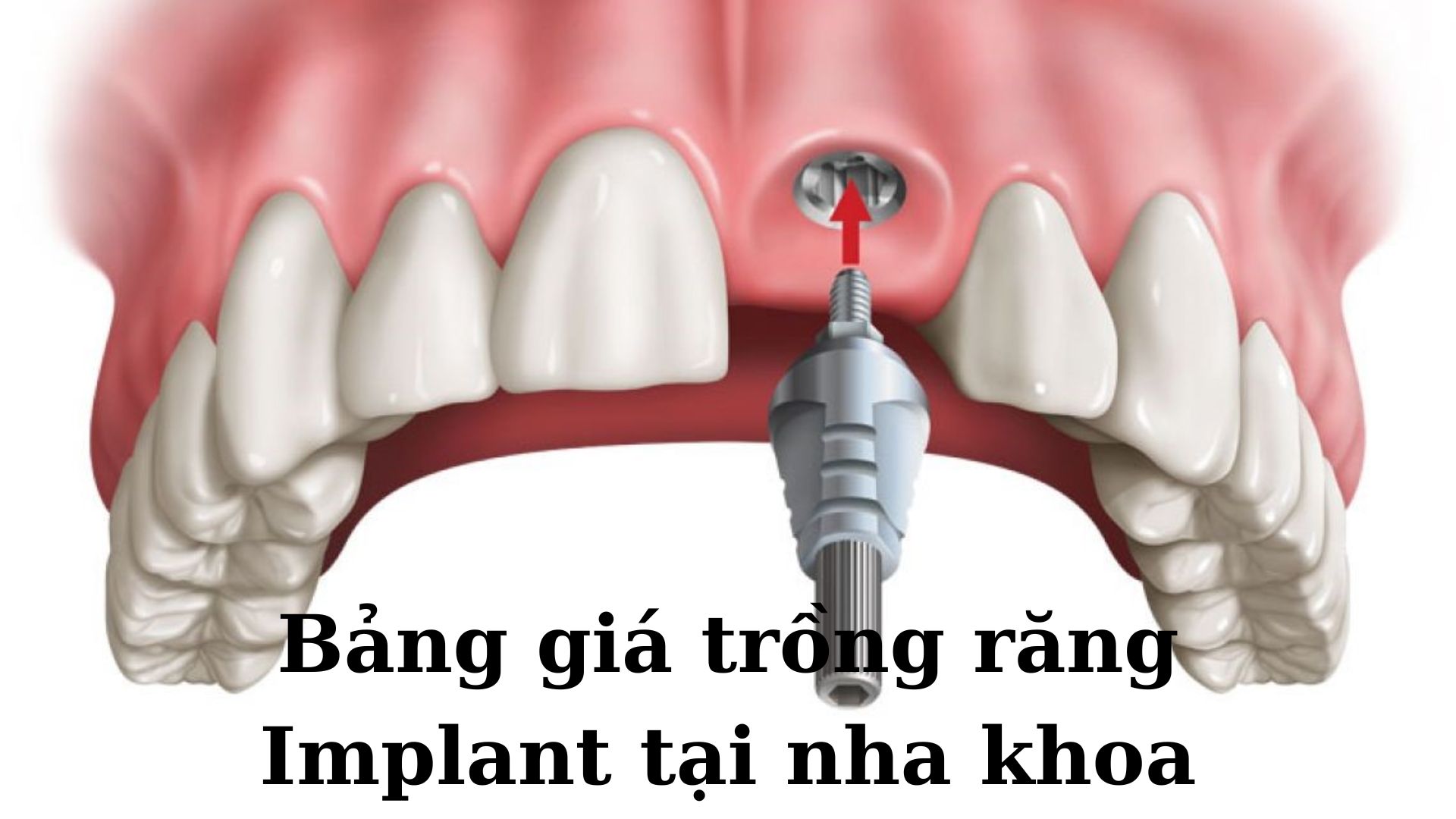 Bảng giá trồng răng Implant - 3