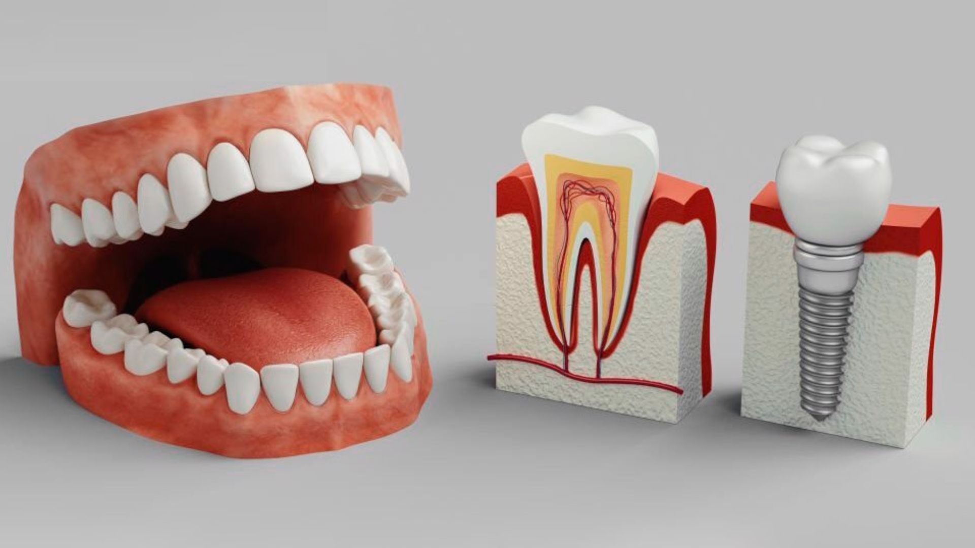 Bảng giá trồng răng Implant - 4
