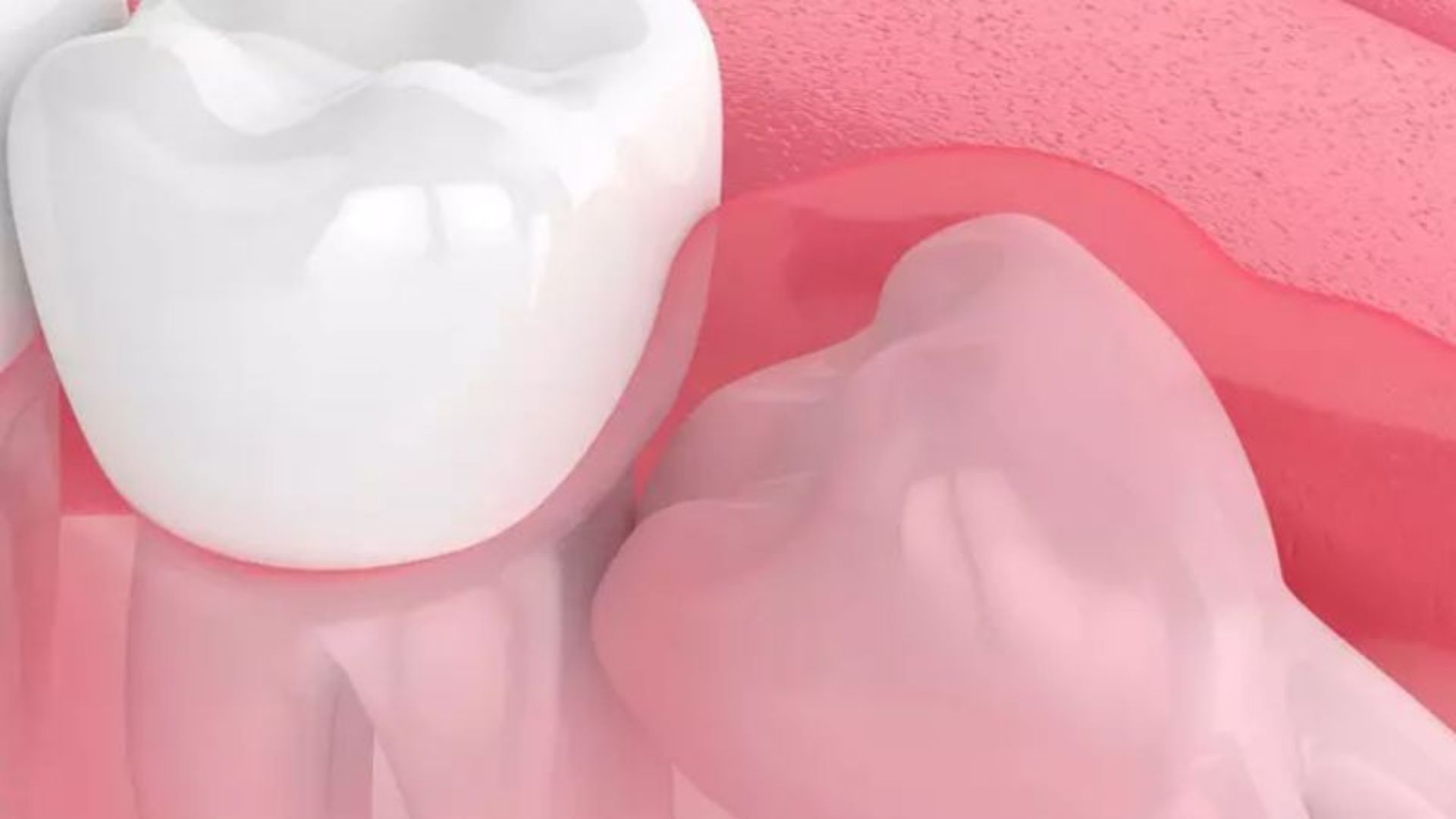 cắt lợi trùm răng khôn - 3