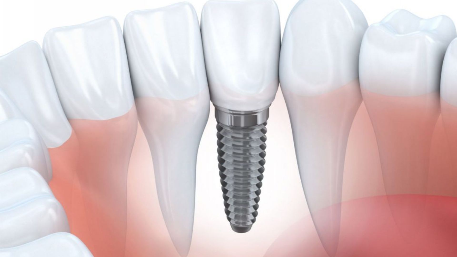Tìm hiểu về trồng răng Implant