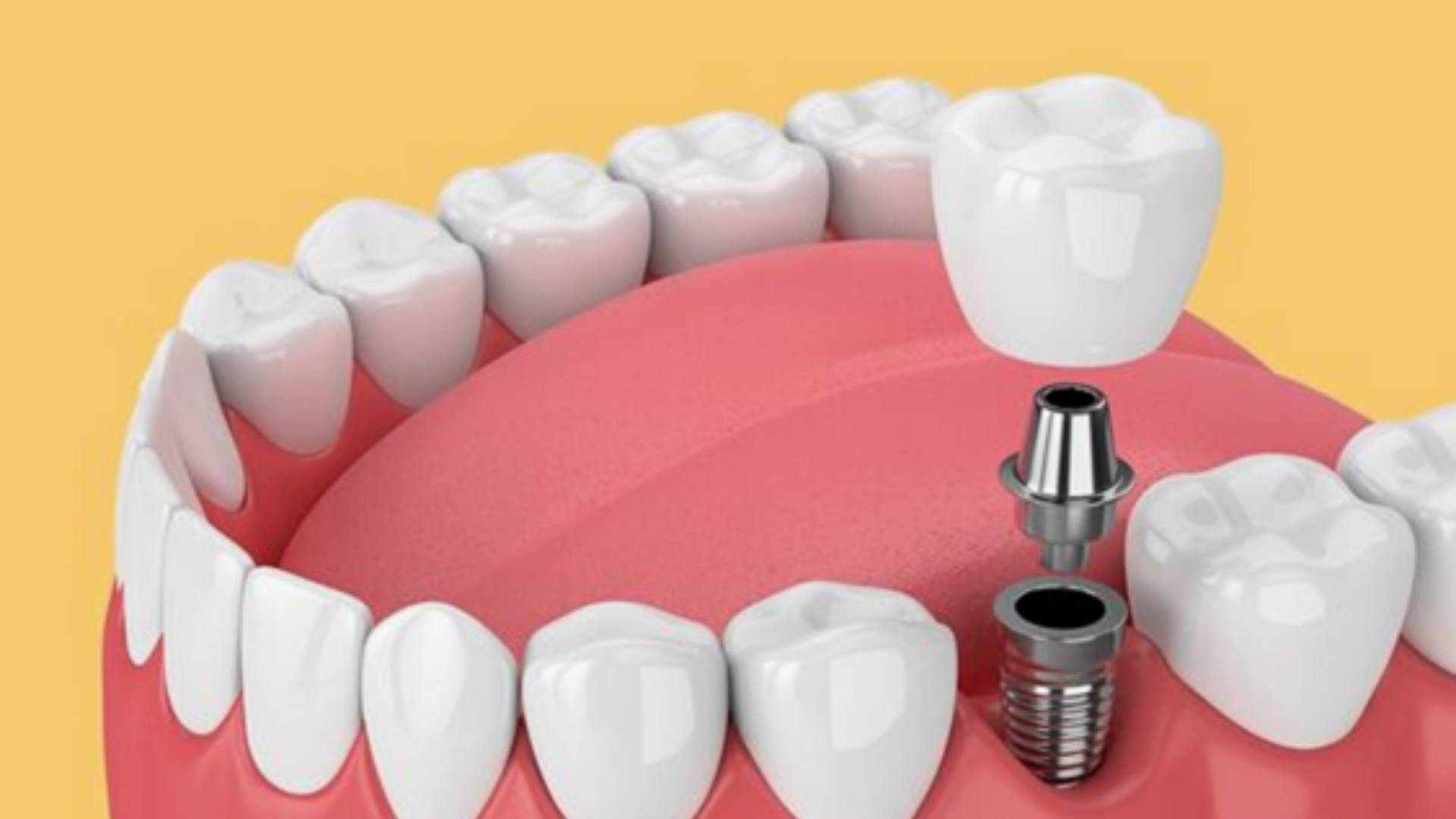trồng răng implant bao lâu thì lành - 5