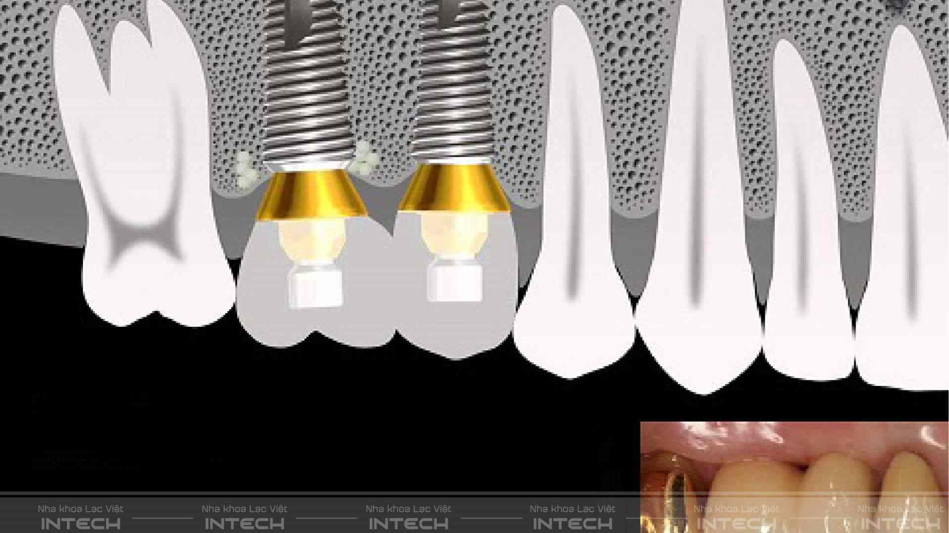 trồng răng implant bao lâu thì lành - 6