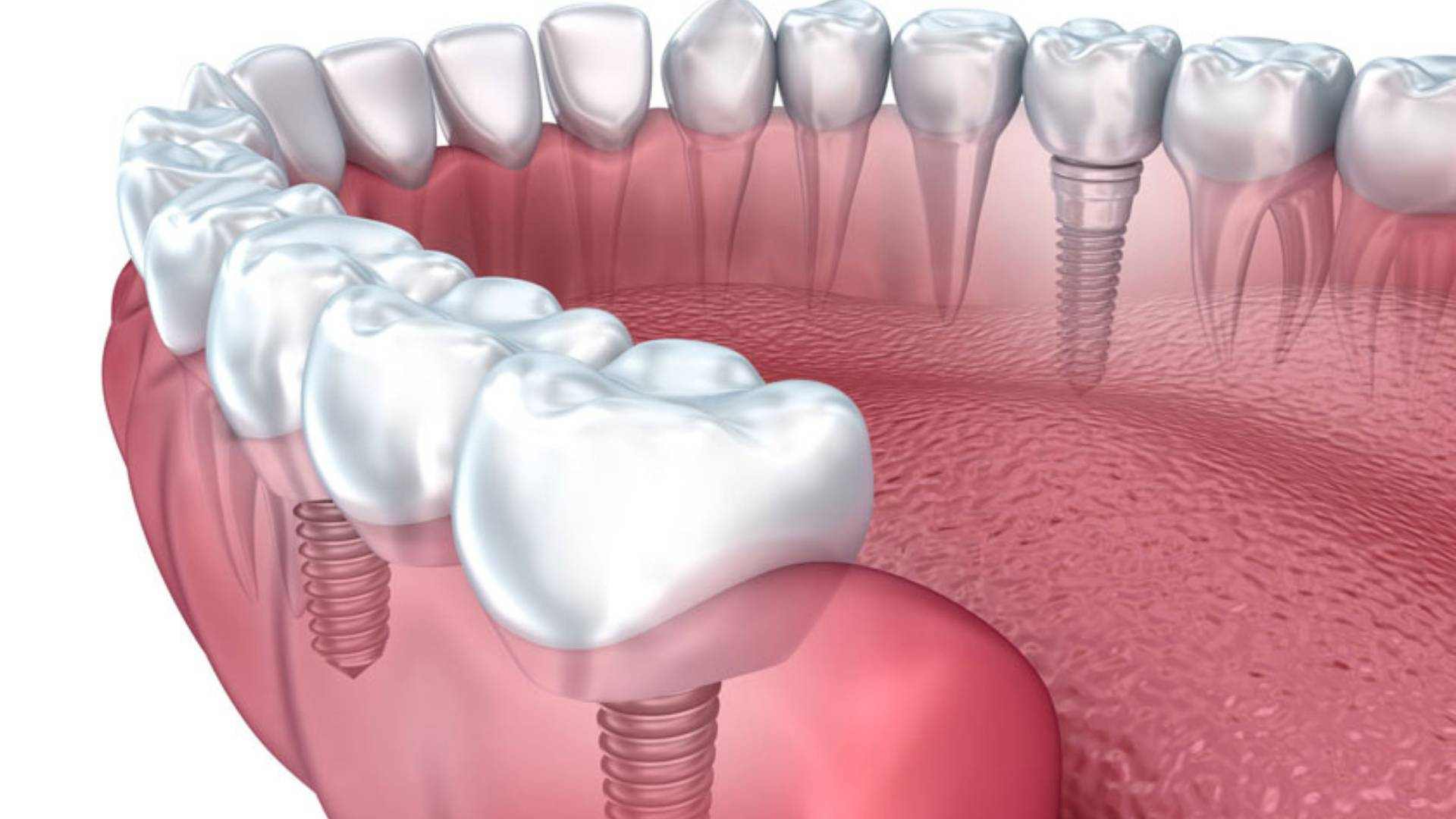 trồng răng implant có chụp mri được không - 3