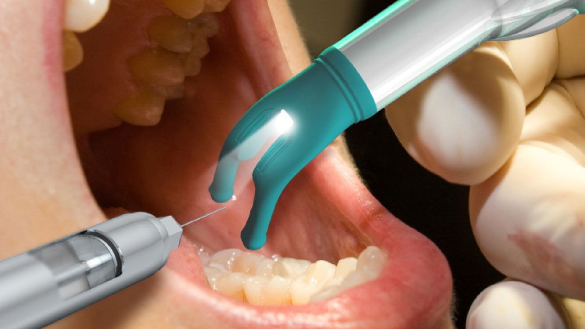 Trồng răng Implant có đau không - 1
