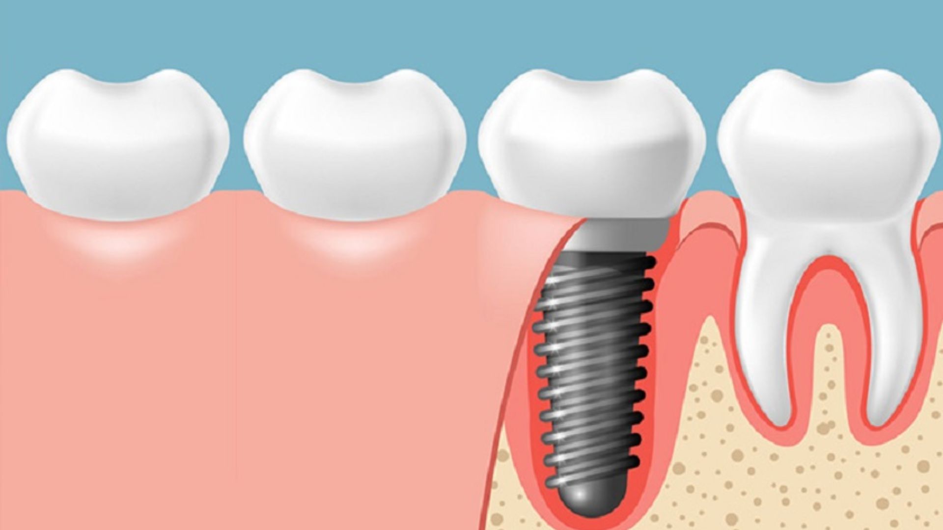 Trồng răng Implant có đau không - 2