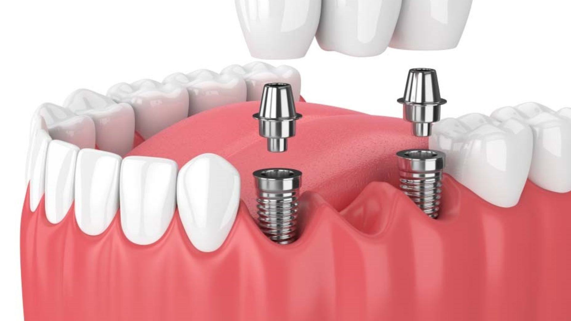 trồng răng implant dùng được bao lâu - 1