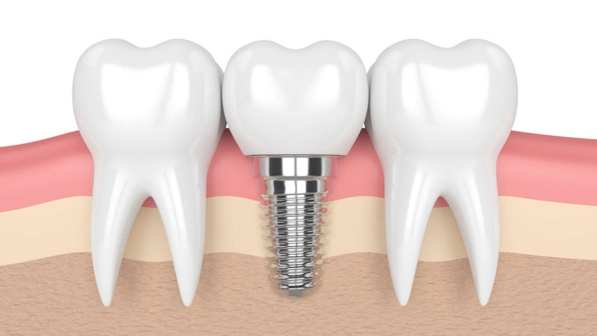 trồng răng implant dùng được bao lâu - 2