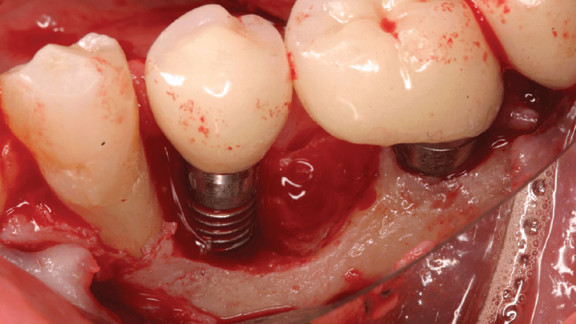 Trồng răng Implant giá rẻ - 3