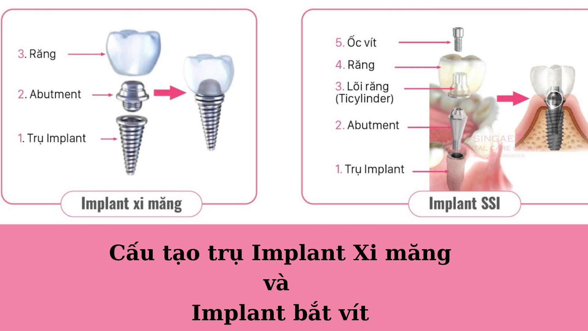 Trồng răng Implant xi măng - 3