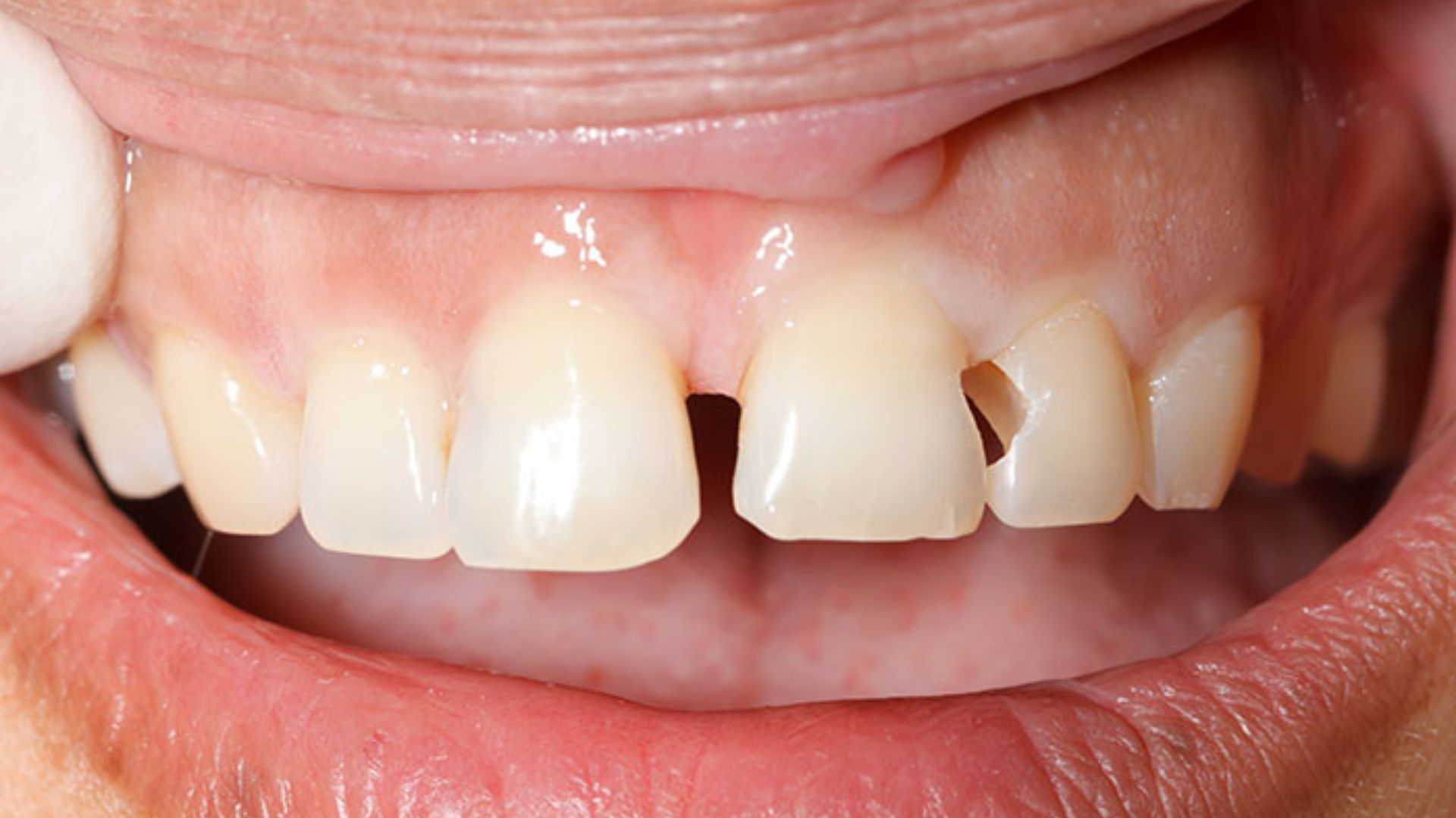Bọc răng sứ có lấy tủy không - 4