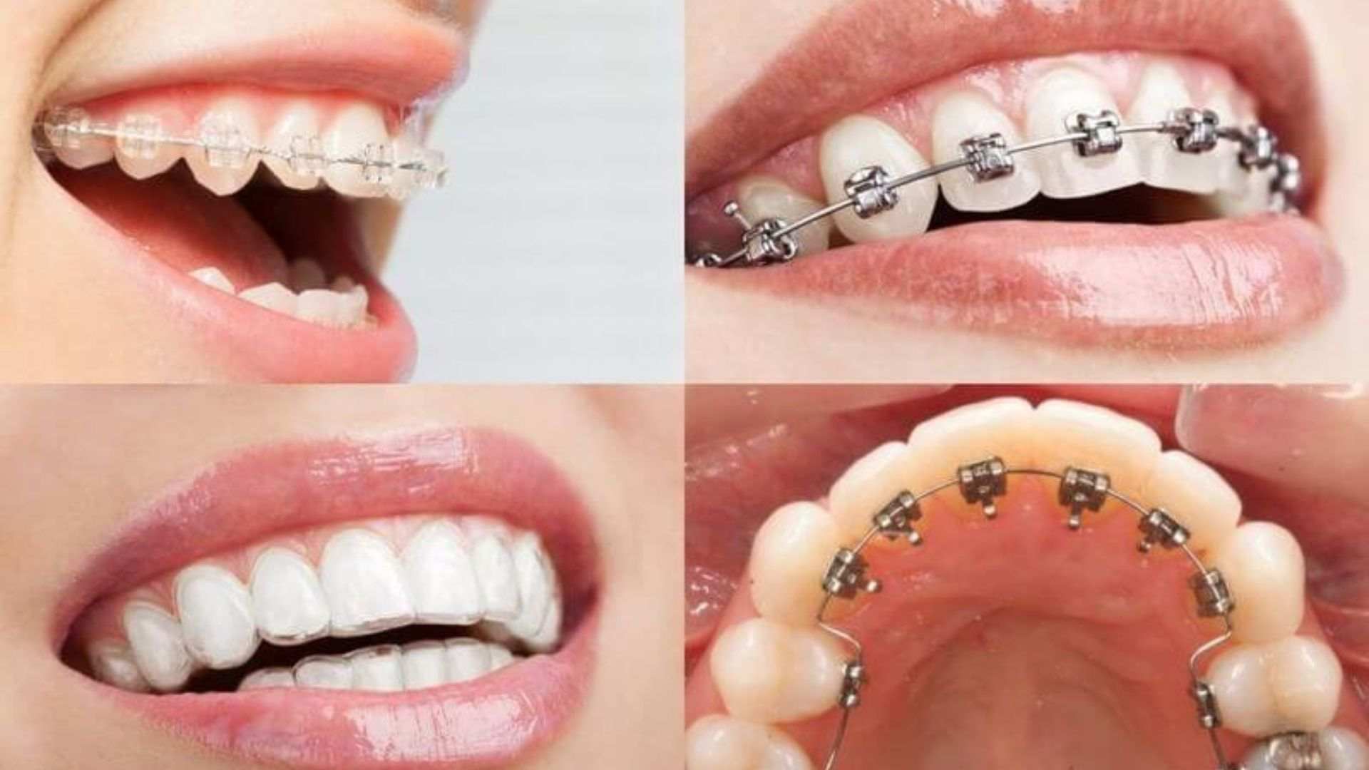 các giai đoạn niềng răng - 5