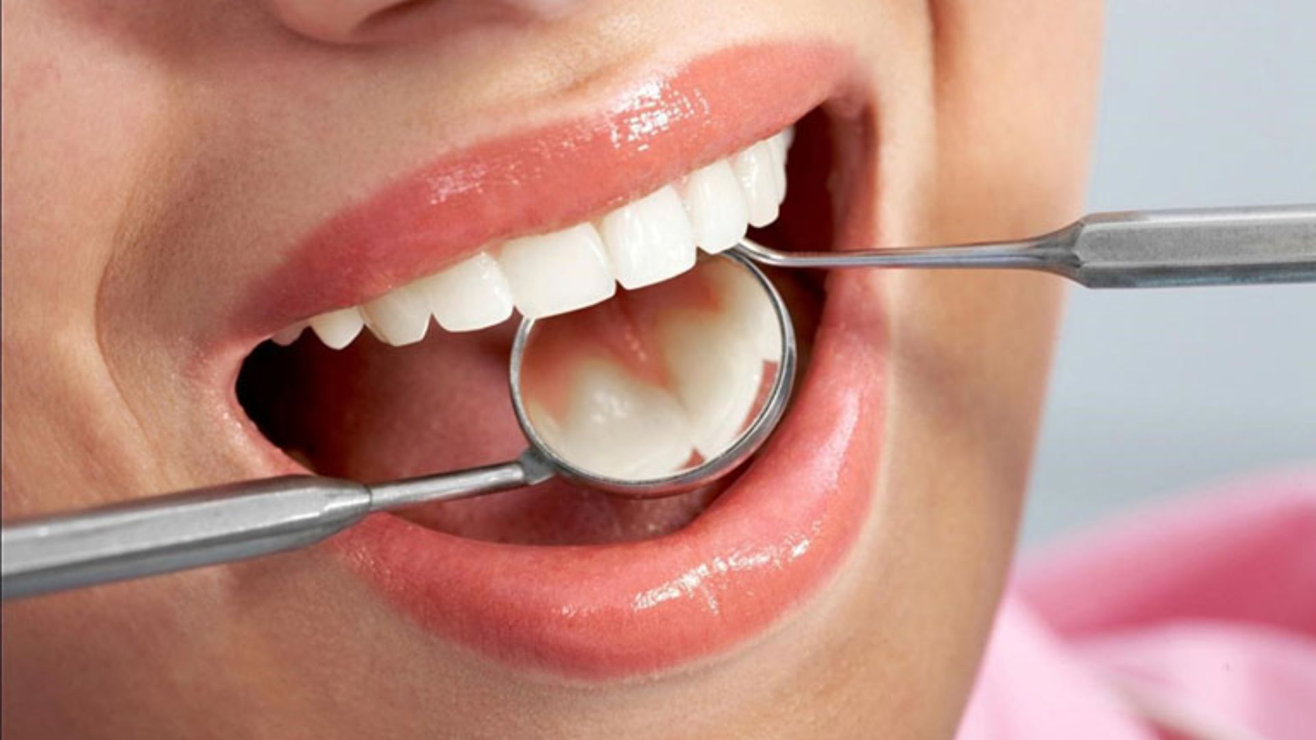 Răng sau lấy tủy tồn tại được lâu 