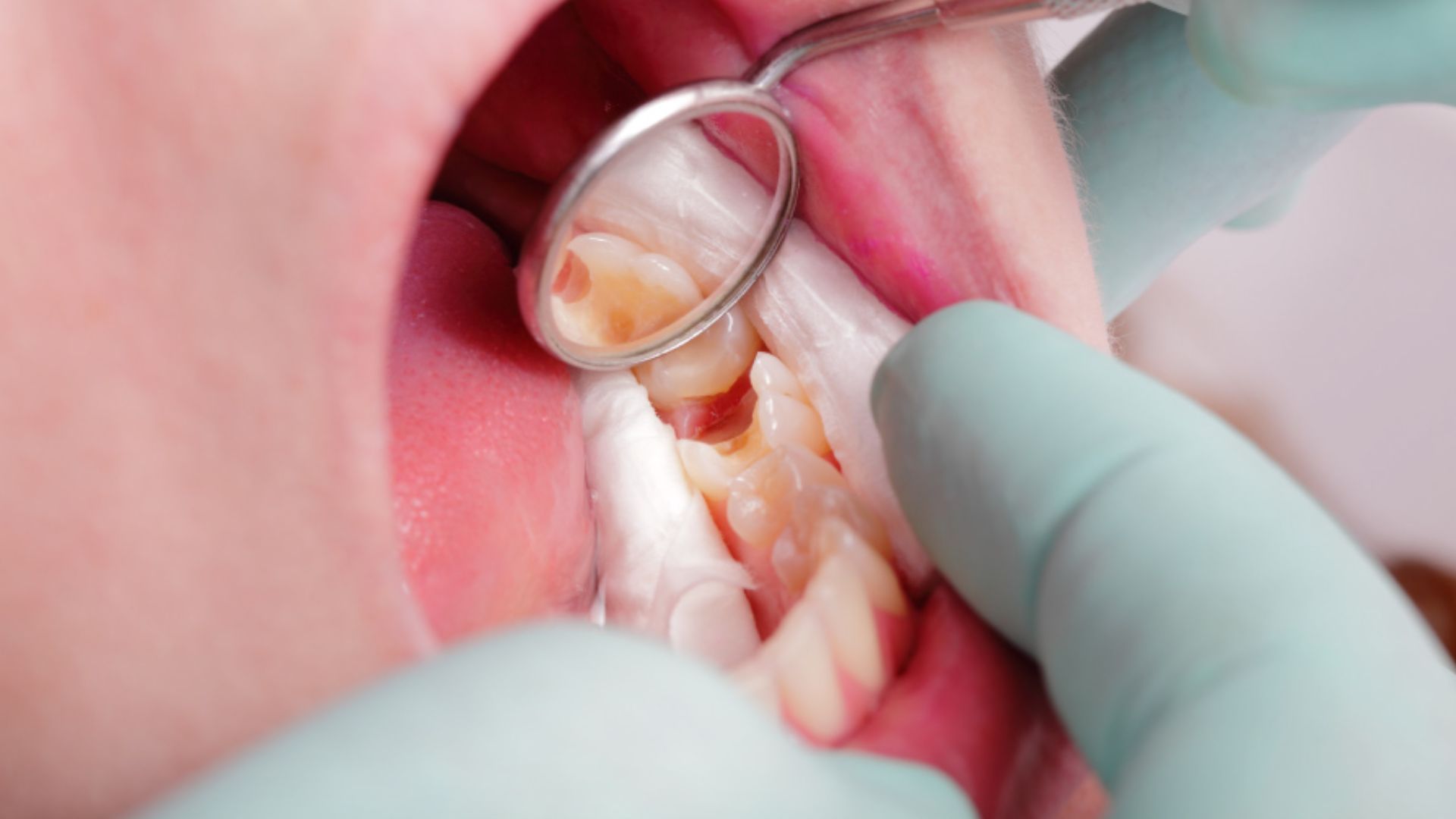 Lấy tủy trong răng bị viêm nhiễm