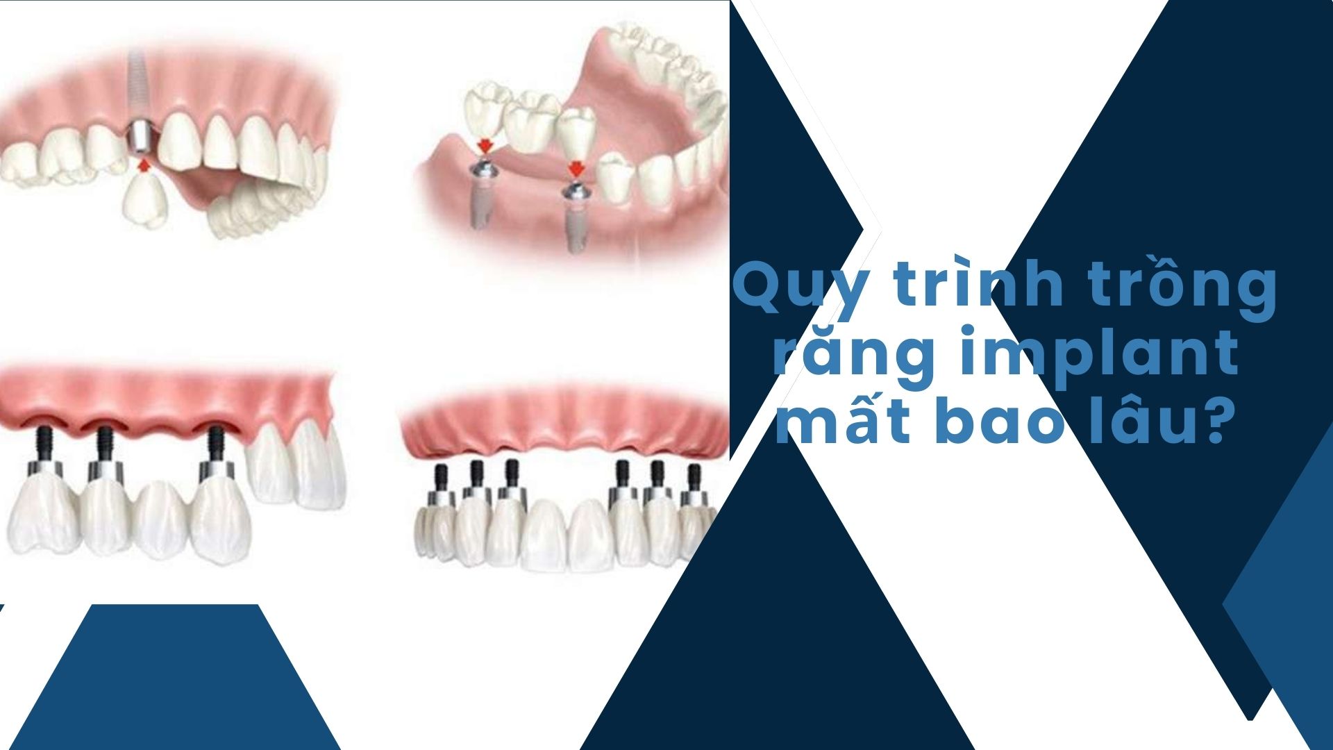 Quy trình trồng răng implant mất bao lâu?