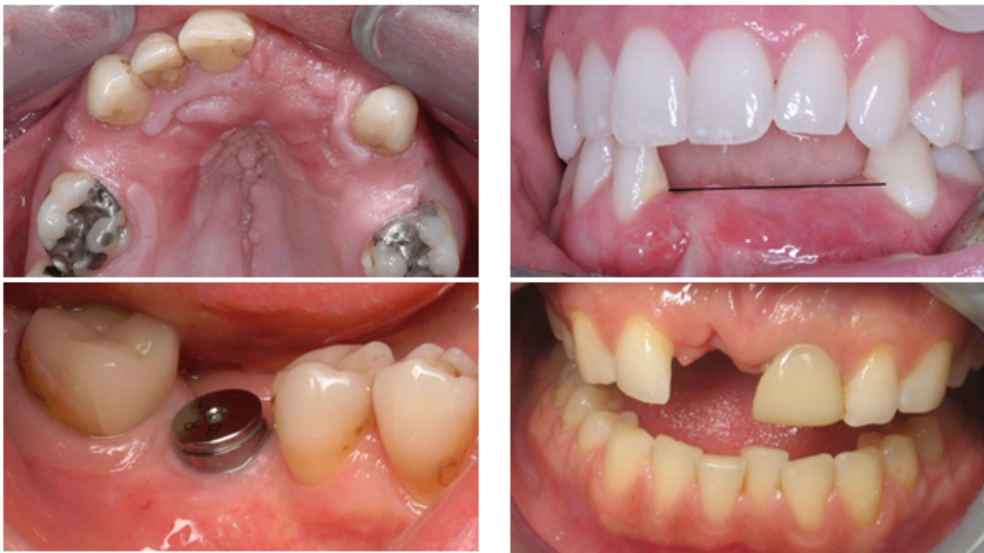 Trồng răng implant có nguy hiểm không -4