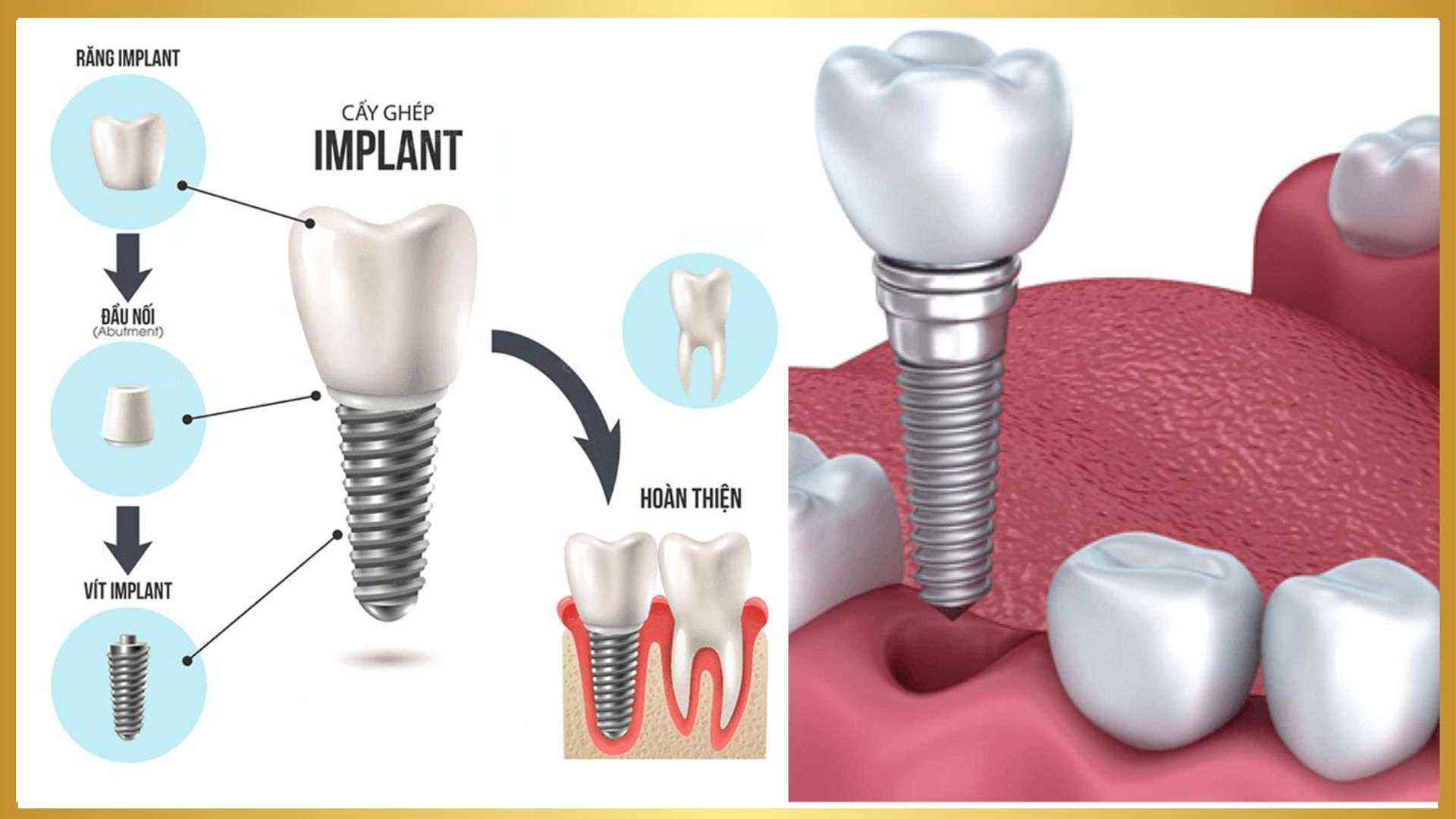 Trồng răng implant trả góp - 4