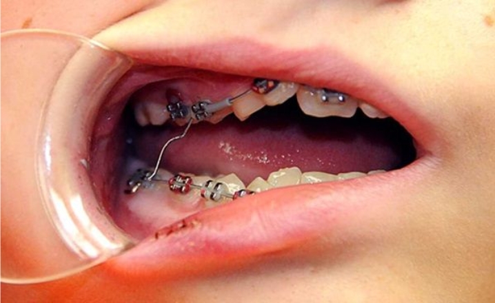 Gây tổn hại cho răng khi không chăm sóc đúng cách