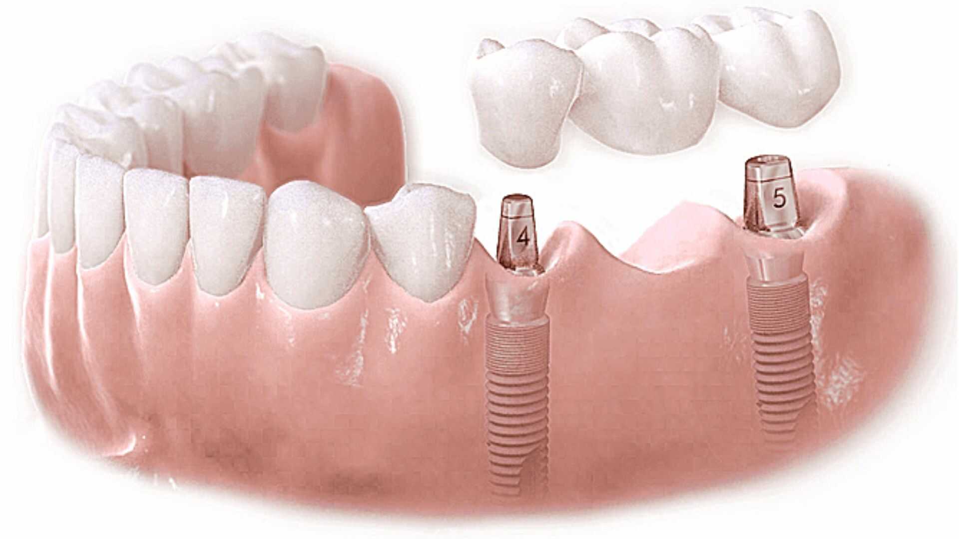 Trồng răng bằng cấy ghép implant có thật sự tốt-2