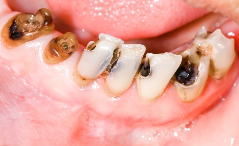 Trồng răng Implant 1